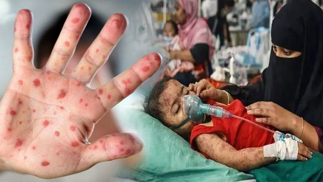 হাম-দৈনিক ইতিহাস